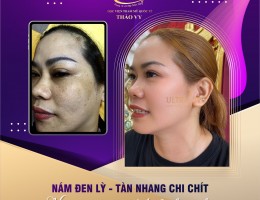 SẠCH CHÂN NÁM 100% - CHỈ SỐ SOI DA QUÁ ĐẸP SAU TRỊ NÁM CỦA CHỊ ÁI - QUẬN 12