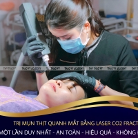 Điều Trị Mụn Thịt Hiệu Quả Tại Thẩm Mỹ Viện Thảo Vy