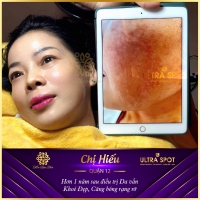 HÀNH TRÌNH TỪ LÀN DA NÁM NẶNG 6 NĂM TRỞ NÊN RẠNG RỠ, SẠCH NÁM TUỔI 50 CỦA CHỊ HIẾU